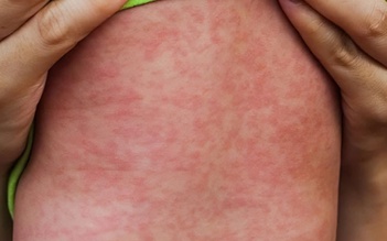 Cảnh báo nhóm nguy cơ cao bị biến chứng nặng do sởi