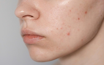 Hyaluronic ZnPCA Mixlab Serum - serum kiềm dầu kháng khuẩn cho da dầu mụn