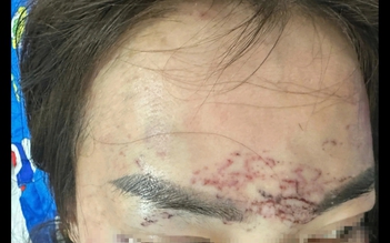 Cà Mau: Một phụ nữ tố bị bắt, đánh đập, xăm mặt, tạt axit vì ghen