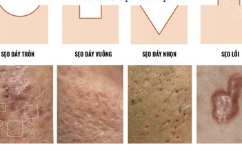 Scar Esthetique: Công nghệ trị sẹo tiên tiến chuẩn y khoa