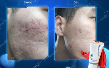Scar Esthetique - Công thức phục hồi ‘cân tất’ mọi tổn thương sau mụn
