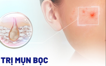 Top 10 kem trị mụn bọc 'cứu tinh' cho da dầu hết sưng, hết đau, không thâm