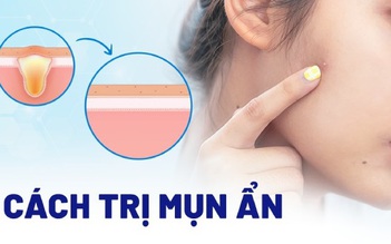 Bật mí cách trị mụn ẩn hiệu quả tại nhà, ngừa tái phát, không để lại sẹo