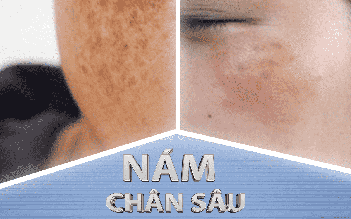 Top 6 kem trị nám chân sâu hiệu quả tại nhà, ngừa tái phát, không bong tróc
