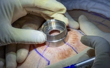 Tái sa trễ sau thẩm mỹ là gì?
