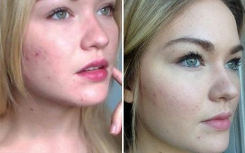 Gợi ý cách trị mụn bọc chuẩn y khoa hiệu quả tại nhà, ngăn ngừa sẹo xấu