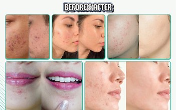 Trị mụn cấp tốc có thực sự an toàn? Lợi ích và tác hại bạn cần biết