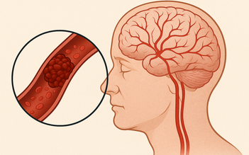 Nghiên cứu mới: Thiết bị loại bỏ cục máu đông chỉ trong vài giây