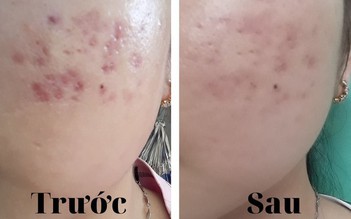 Có cách nào trị thâm sẹo lâu năm hiệu quả tại nhà, tốn ít chi phí?