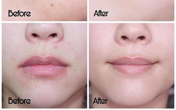 Top 5 kem dưỡng phục hồi sau trị mụn ai cũng 'mê' ngay lần đầu tiên
