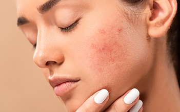 Da kích ứng vì thời tiết - Phục hồi như thế nào?
