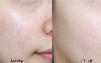 Top 4 sản phẩm trị mụn cấp tốc cho da nhạy cảm, dịu nhẹ không kích ứng