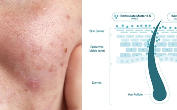 Giải pháp làm sạch an toàn đánh bay bụi mịn PM2.5 - Thủ phạm gây mụn ẩn