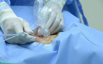 Đột phá mới trong điều trị hạch cổ tái phát sau ung thư tuyến giáp