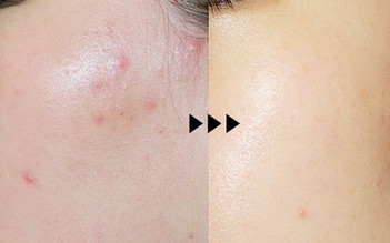 Top 5 kem giảm mụn viêm sưng xẹp nhanh, ngăn tái phát và ngừa sẹo hiệu quả