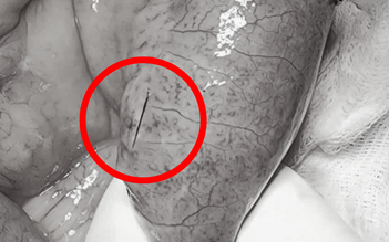 Cụ ông bị mảnh xương cá dài 4 cm cứa thủng ruột