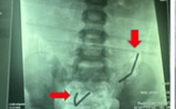 TP.HCM: Nuốt 20 viên nam châm, ruột non bé trai bị thủng 8 lỗ