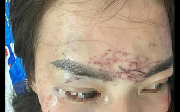 Vụ đánh ghen xăm mặt ở Cà Mau: Đề nghị truy tố 2 bị can