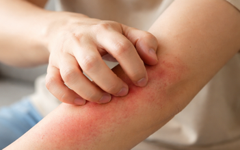 Bị ngứa kéo dài, khi nào là dấu hiệu cảnh báo ung thư?