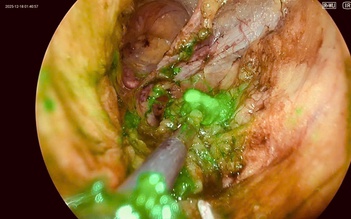 Lần đầu tiên Việt Nam ứng dụng kỹ thuật mới điều trị ung thư phụ khoa