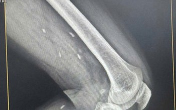 Kén sán rải rác trong vùng đùi và cẳng chân bệnh nhân