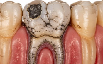 Vì sao thạch tín bị 'khai tử' ở nha khoa chính thống?