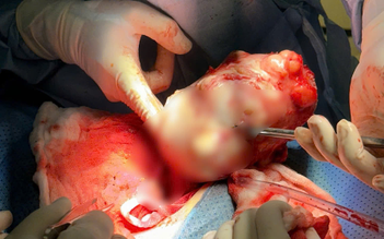 Bóc u xơ to vị trí hiếm, bảo tồn tử cung thành công tại BV Phương Nam