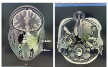 Đau hàm, nghẹt mũi, chảy máu răng - Đi khám phát hiện ung thư xoang