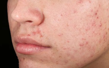 Da sau mụn nhạy cảm kéo dài: Khi hàng rào da chưa thực sự hồi phục