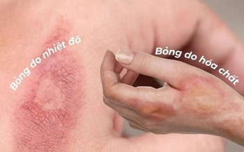 Cứ nghĩ sẹo bỏng phải xâm lấn nhưng dùng kem mờ sẹo vẫn hiệu quả nhanh chóng