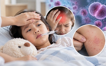 Não mô cầu: Khi nào cần cảnh giác với sốt, đau đầu, phát ban?
