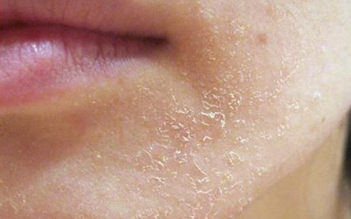 Giải mã lotion dưỡng ẩm, kiềm dầu cho da mụn nhạy cảm đang được chú ý