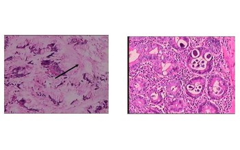 Đi chân đất, dùng corticoid tùy tiện: Nguy cơ giun lươn gây biến chứng nguy hiểm