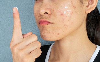 Da vùng má dễ bị thâm mụn? Cách chăm sóc da giúp da đều màu hơn