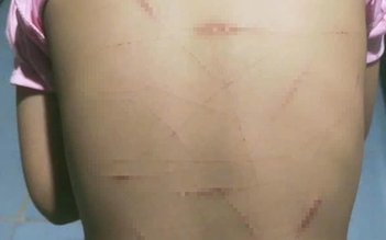 Vụ học sinh lớp 5 ở Cà Mau nghi bị bạo hành: Chưa đủ tuổi xử lý