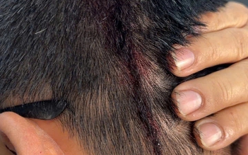 TP.HCM: Điều tra vụ người đàn ông bị hàng xóm tấn công gây thương tích