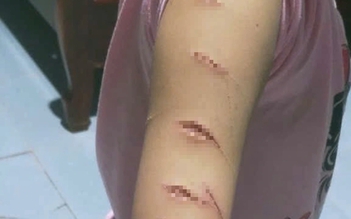 Cà Mau: Học sinh lớp 5 đến lớp với nhiều vết thương, nghi bị bạo hành