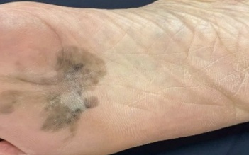 Nhận biết sớm ung thư từ vùng da đổi màu ở bàn tay, bàn chân