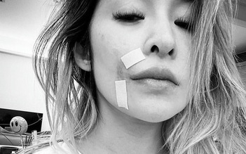 Diva Đài Loan Tiêu Á Hiên biến dạng gương mặt sau khi bị chó tấn công