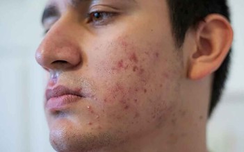 Nam giới bị sẹo rỗ: Khi nào da còn khả năng tăng sinh collagen để cải thiện?