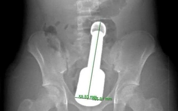 Chày kim loại kẹt trong trực tràng khiến thiếu niên 15 tuổi phải cấp cứu trong đêm