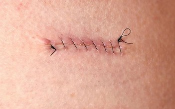 Kiểm soát viêm sau phẫu thuật - Yếu tố quyết định hình thái sẹo