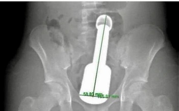 Chày kim loại kẹt trong trực tràng: Tuổi dậy thì và tâm lý 'một mình, thử xem sao'