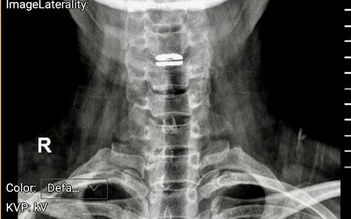 Sai lầm khi trị đau cổ vai gáy có thể gây liệt