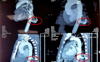 Việt Nam lần đầu dùng robot mổ điều trị phổi biệt lập thành công