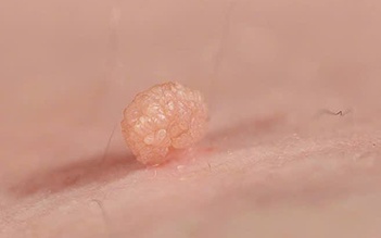 Tình dục không an toàn, nam bệnh nhân gần 70 tuổi mắc sùi mào gà