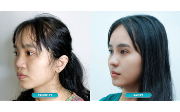 Bệnh viện JK Nhật Hàn miễn phí phẫu thuật 20 case mũi