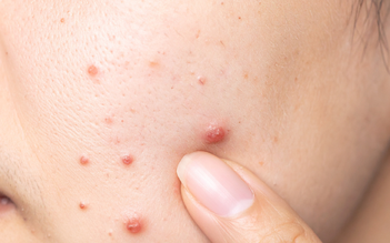 Vừa nặn mụn xong nên bôi gì để giảm đỏ nhanh hạn chế để lại sẹo rỗ