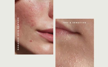 Da yếu là gì? Dấu hiệu và cách phục hồi hiệu quả trong 4 tuần