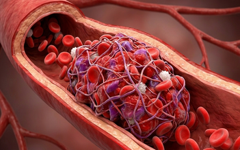 Vì sao tiểu đường lại dễ gây đột quỵ?